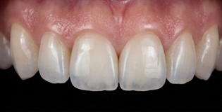 Behandeling met composietbonding
