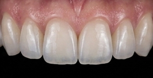 Behandeling met E-max-veneers
