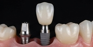 Behandeling met tandimplantaten