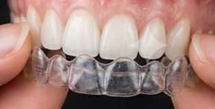 Invisalign-behandeling met transparante aligners
