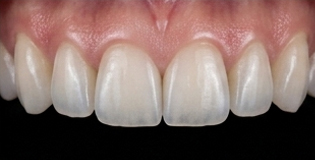 Behandeling met tandveneers